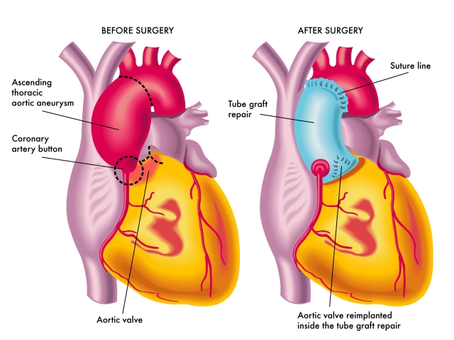 Thoracic Surgery in India